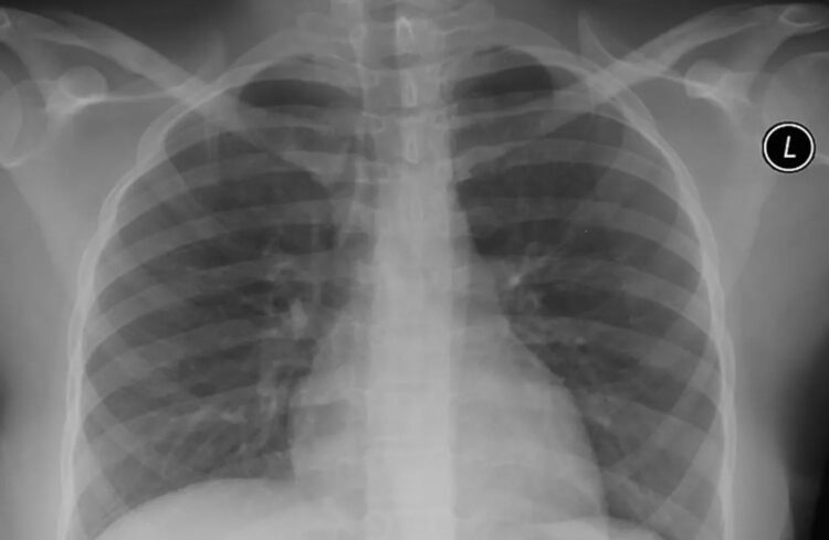 Houd je longen gezond: 8 tips om ze te reinigen (veel mensen weten dit niet)