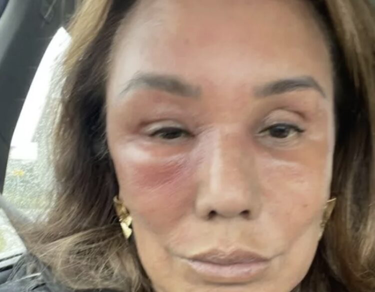 Grote zorgen om Patty Brard (70): met spoed naar het ziekenhuis, fans geschrokken van onheilspellende foto