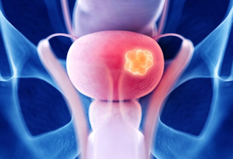 Nieuw onderzoek wijst uit: Steeds meer gevallen van blaaskanker ‘Klachten worden verward met blaasontsteking’