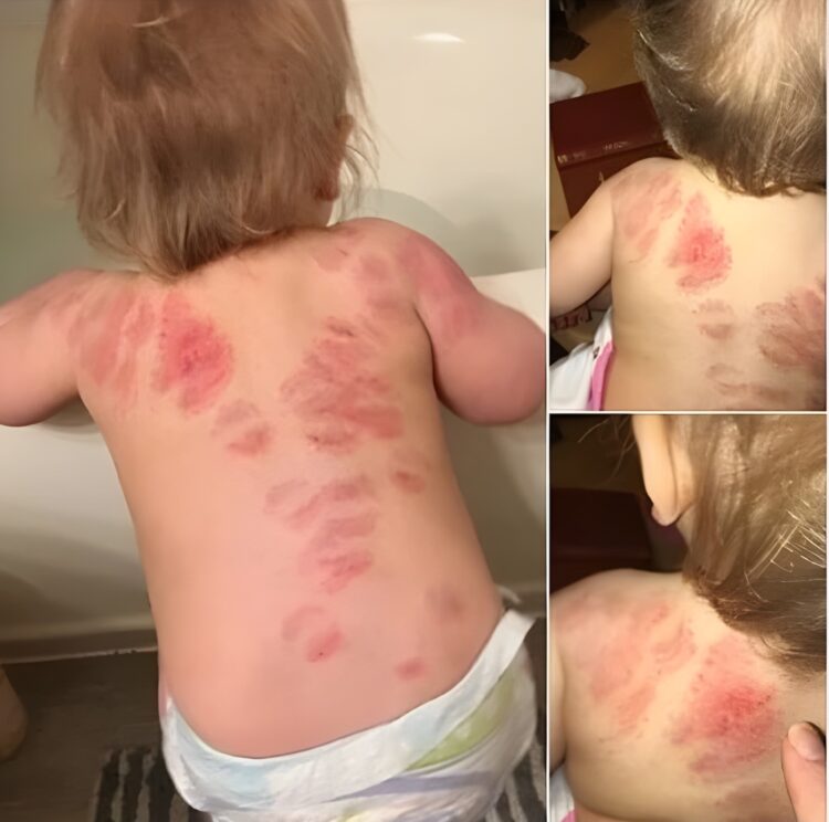 Moeder in shock na opvangdrama: Mijn dochter (1) is 25 keer gebeten op de opvang en niemand zei iets