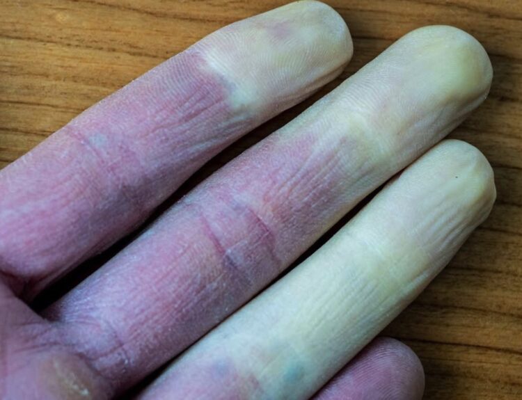 Artsen waarschuwen voor vingers die van kleur veranderen: dit moet je weten!