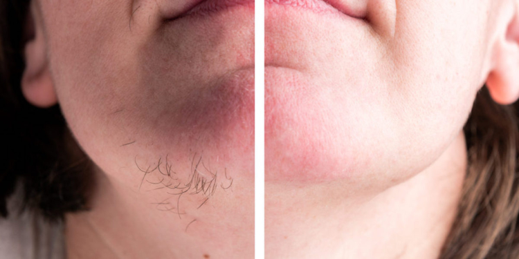 Dames opgelet! Daarom krijg je als je ouder bent vaker haren op je kin