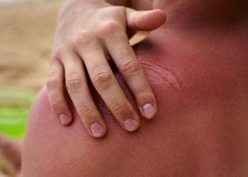 Huidfonds waarschuwt iedereen voor de zon: ‘Zegt veel meer dan temperatuur’