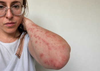 HEFTIG! Vrouw (31) doet schokkende ontdekking na hotelnacht: ‘Meer dan 100 keer gebeten’